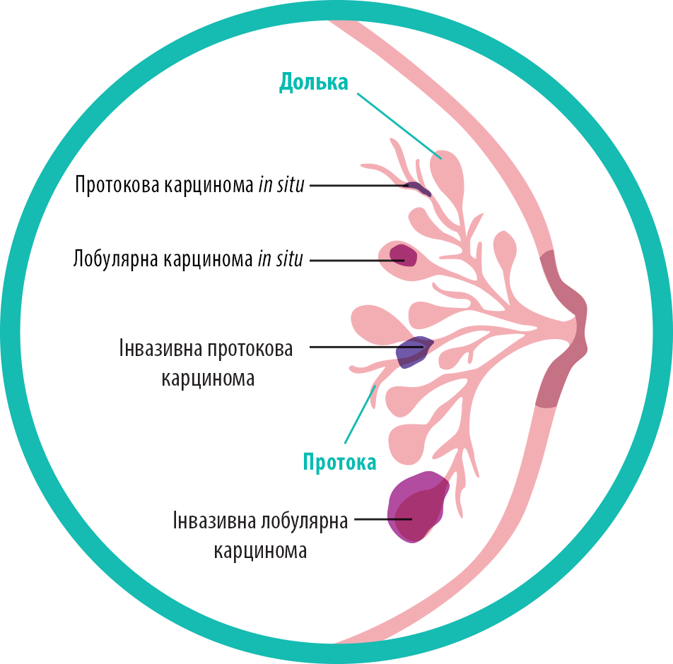 Типи і підтипи раку молочної залози